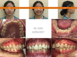 Hình ảnh niềng răng khấp khểnh nặng không nhổ răng bằng phương pháp di xa răng hàm Bs Việt Anh - Ca 4
