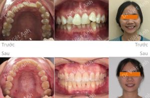 Hình ảnh niềng răng khấp khểnh nặng không nhổ răng bằng phương pháp di xa răng hàm Bs Việt Anh - Ca 4