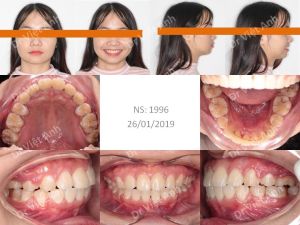 Hình ảnh niềng răng hô thành công mỹ mãn sau 19 tháng Bs Việt Anh - Ca 5