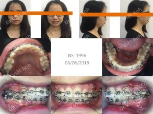 Hình ảnh niềng răng hô thành công mỹ mãn sau 19 tháng Bs Việt Anh - Ca 5
