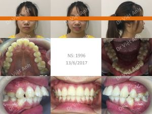 Hình ảnh niềng răng hô thành công mỹ mãn sau 19 tháng Bs Việt Anh - Ca 5
