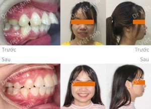 Hình ảnh niềng răng hô thành công mỹ mãn sau 19 tháng Bs Việt Anh - Ca 5