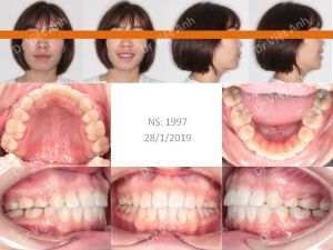Hình ảnh ca hô cả xương và răng có được góc nghiêng thần thánh sau niềng răng Bs Việt Anh - Ca 6