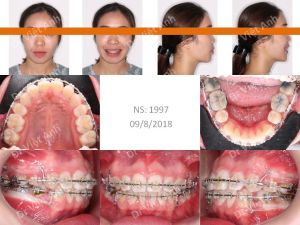 Hình ảnh ca hô cả xương và răng có được góc nghiêng thần thánh sau niềng răng Bs Việt Anh - Ca 6
