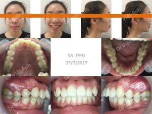 Hình ảnh ca hô cả xương và răng có được góc nghiêng thần thánh sau niềng răng Bs Việt Anh - Ca 6