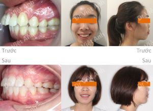 Hình ảnh ca hô cả xương và răng có được góc nghiêng thần thánh sau niềng răng Bs Việt Anh - Ca 6