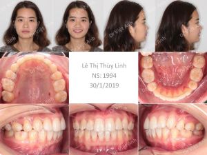 Hình ảnh niềng răng hô và khểnh hoàn thành sau 2 năm bằng mắc cài mặt trong - Ca 7