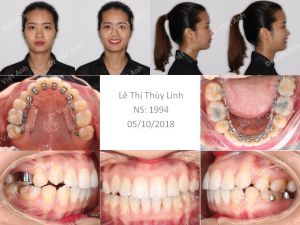 Hình ảnh niềng răng hô và khểnh hoàn thành sau 2 năm bằng mắc cài mặt trong - Ca 7