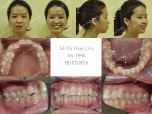 Hình ảnh niềng răng hô và khểnh hoàn thành sau 2 năm bằng mắc cài mặt trong - Ca 7