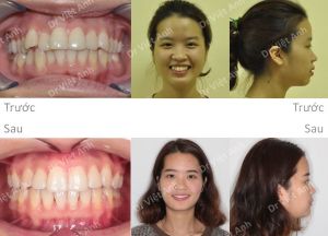 Hình ảnh niềng răng hô và khểnh hoàn thành sau 2 năm bằng mắc cài mặt trong - Ca 7