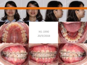 Hình ảnh niềng răng hô, lộn xộn, nhổ răng hỏng tủy thay vì răng số 4 - Ca 8