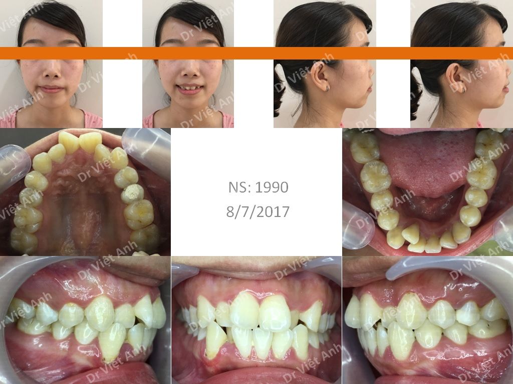 Cập nhật hơn 51 về hình ảnh răng  Du học Akina