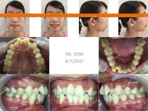 Hình ảnh niềng răng hô, lộn xộn, nhổ răng hỏng tủy thay vì răng số 4 - Ca 8