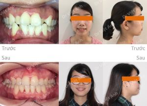 Hình ảnh niềng răng hô, lộn xộn, nhổ răng hỏng tủy thay vì răng số 4 - Ca 8