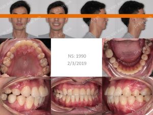 Hình ảnh niềng răng giảm hô tận dụng khoảng mất răng số 6 hàm dưới - Ca 9