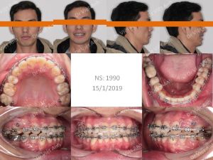 Hình ảnh niềng răng giảm hô tận dụng khoảng mất răng số 6 hàm dưới - Ca 9
