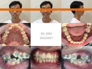 Hình ảnh niềng răng giảm hô tận dụng khoảng mất răng số 6 hàm dưới - Ca 9