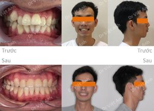 Hình ảnh niềng răng giảm hô tận dụng khoảng mất răng số 6 hàm dưới - Ca 9