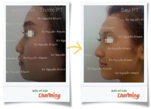 Hình ảnh sửa mũi gồ bs Nguyễn Khanh - Ca 3