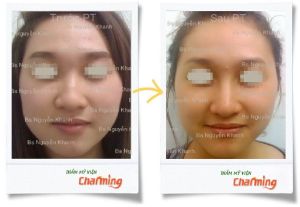 Hình ảnh sửa mũi gồ bs Nguyễn Khanh - Ca 3