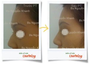 Hình ảnh sửa mũi gồ bs Nguyễn Khanh - Ca 4