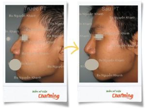 Hình ảnh sửa mũi gồ bs Nguyễn Khanh - Ca 5