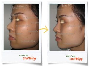 Hình ảnh sửa mũi lại bs Nguyễn Khanh - Ca 10