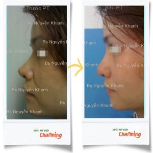 Hình ảnh sửa mũi lại bs Nguyễn Khanh - Ca 11
