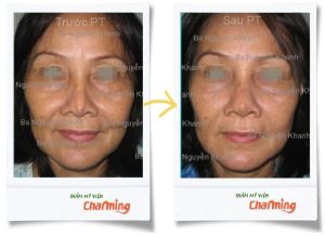 Hình ảnh sửa mũi lại bs Nguyễn Khanh - Ca 12