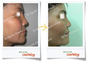 Hình ảnh sửa mũi lại bs Nguyễn Khanh - Ca 13