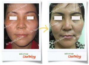 Hình ảnh sửa mũi lại bs Nguyễn Khanh - Ca 13