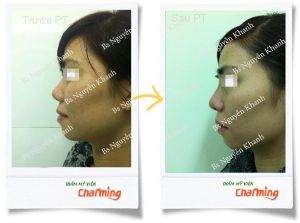 Hình ảnh sửa mũi lại bs Nguyễn Khanh - Ca 14