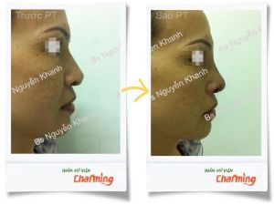 Hình ảnh sửa mũi lại bs Nguyễn Khanh - Ca 15