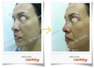 Hình ảnh sửa mũi lại bs Nguyễn Khanh - Ca 15