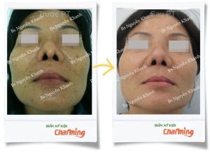 Hình ảnh sửa mũi lại bs Nguyễn Khanh - Ca 16