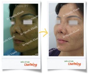 Hình ảnh sửa mũi lại bs Nguyễn Khanh - Ca 16