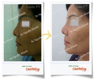 Hình ảnh sửa mũi lại bs Nguyễn Khanh - Ca 16