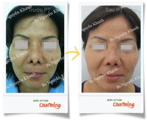 Hình ảnh sửa mũi lại bs Nguyễn Khanh - Ca 16