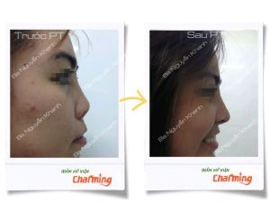 Hình ảnh sửa mũi lại bs Nguyễn Khanh - Ca 17