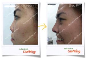 Hình ảnh sửa mũi lại bs Nguyễn Khanh - Ca 17