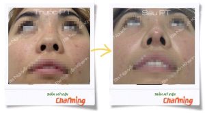 Hình ảnh sửa mũi lại bs Nguyễn Khanh - Ca 17