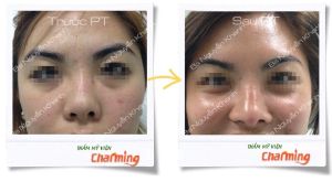 Hình ảnh sửa mũi lại bs Nguyễn Khanh - Ca 17