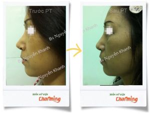 Hình ảnh sửa mũi lại bs Nguyễn Khanh - Ca 6