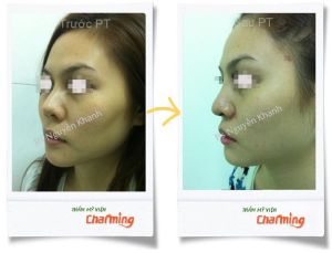 Hình ảnh sửa mũi lại bs Nguyễn Khanh - Ca 7