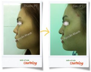 Hình ảnh sửa mũi lại bs Nguyễn Khanh - Ca 7