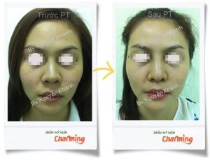 Hình ảnh sửa mũi lại bs Nguyễn Khanh - Ca 7