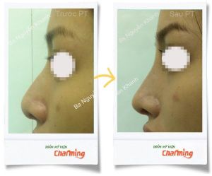 Hình ảnh sửa mũi lại bs Nguyễn Khanh - Ca 8