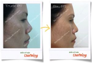 Hình ảnh sửa mũi lại bs Nguyễn Khanh - Ca 9