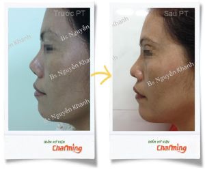 Hình ảnh sửa mũi lại bs Nguyễn Khanh - Ca 9