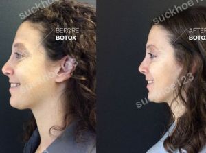 Hình ảnh tiêm Botox trước sau Dr Tâm – ca 40
